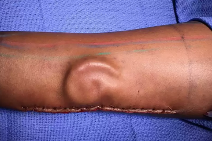 Vrouw krijgt nieuw oor dat op haar arm groeide