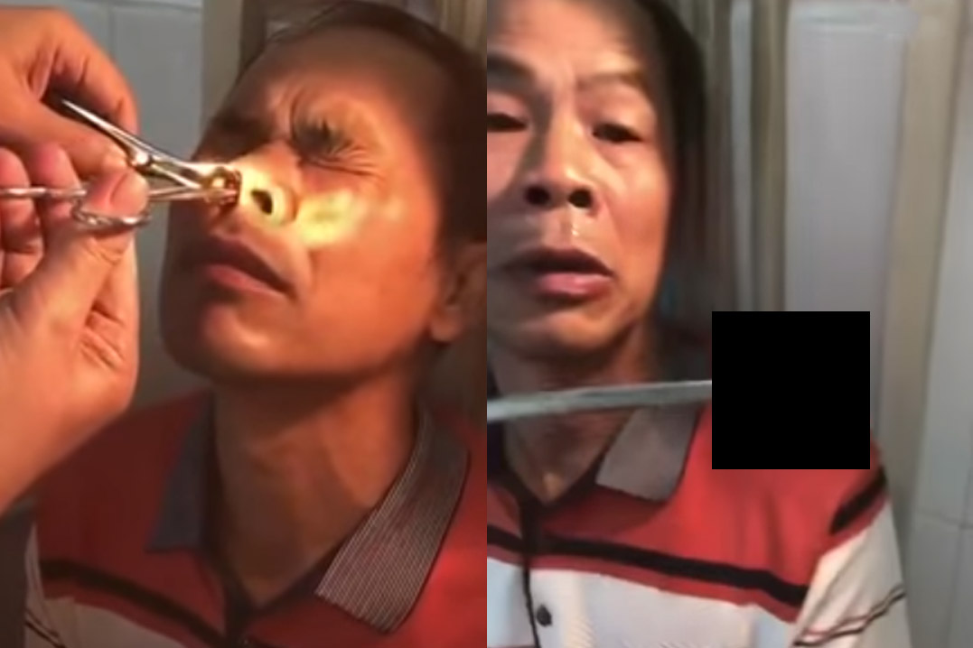 Man heeft al TIEN DAGEN last van een bloedneus. En dan haalt de dokter DIT uit zijn neus! (nsfw-video)