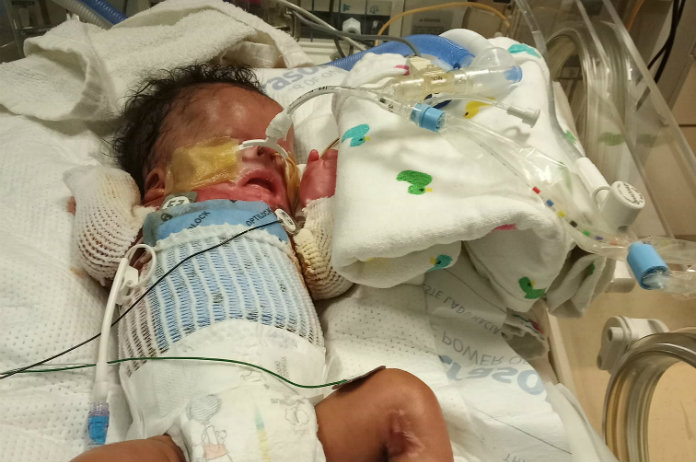 Erg! Baby met genetische aandoening geboren zonder huid