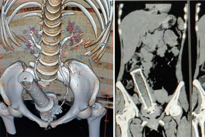 Motorhandvat zat jarenlang vast in vagina van vrouw