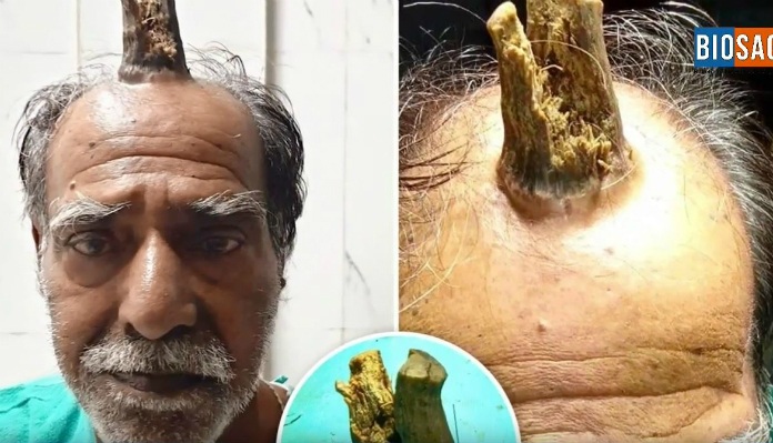 BIZAR. Indiër verlost van “duivelshoorn” op zijn hoofd