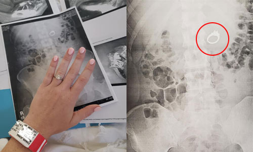 Vrouw ‘droomt’ dat ze haar verlovingsring inslikt. Maar wanneer ze ontwaakt, moet ze naar het ziekenhuis! (foto’s)