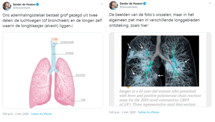 Longarts toont aan wat het coronavirus met je longen doet