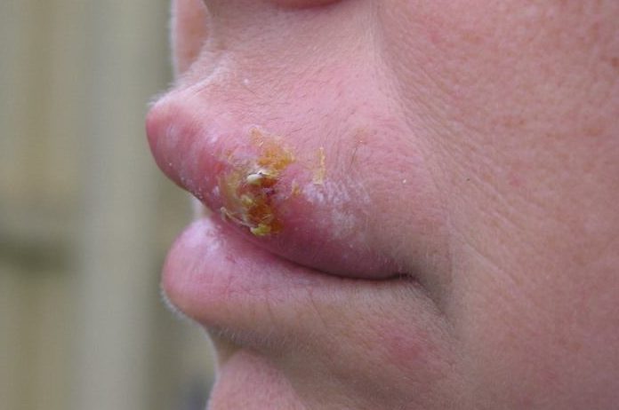 BIZAR. Man eist 150.000 euro schadevergoeding van date nadat hij herpes opliep door kus