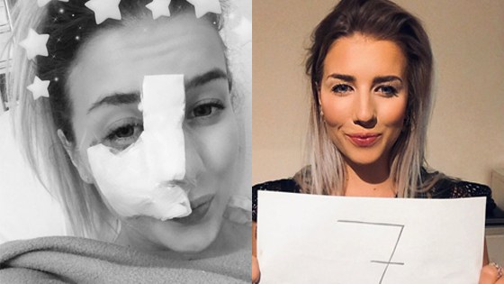 Laura uit ‘Blind Getrouwd’ toont wijnvlek: “Frustrerend om me elke keer te schminken voor ik naar bakker kan” (foto’s)