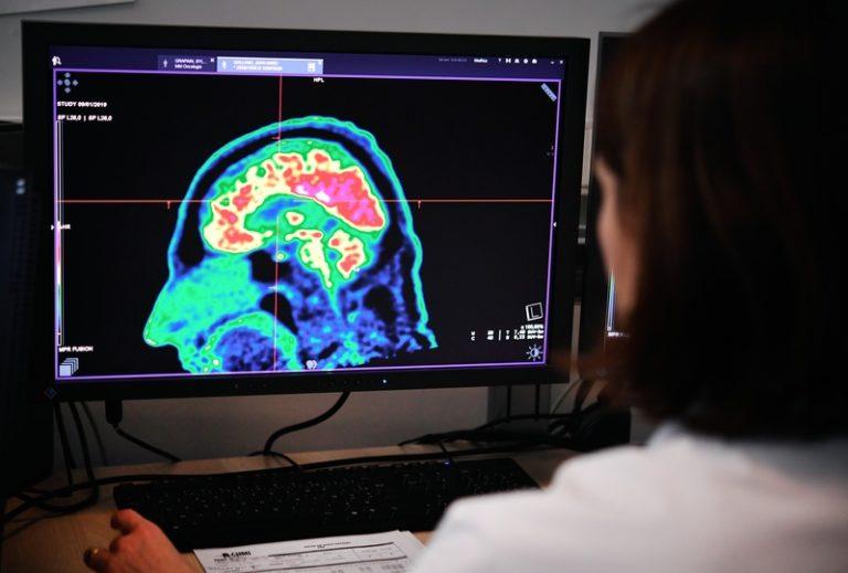 Coronavirus: neurologen waarschuwen voor ernstige hersenaandoeningen bij patiënten met milde symptomen