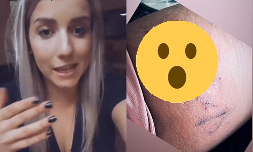 Laura uit ‘Blind Getrouwd’ toont nieuwe foto van GRUWELIJKE brandwonde en geeft update: “Het maakt mij er niet sexyer op!” (foto)