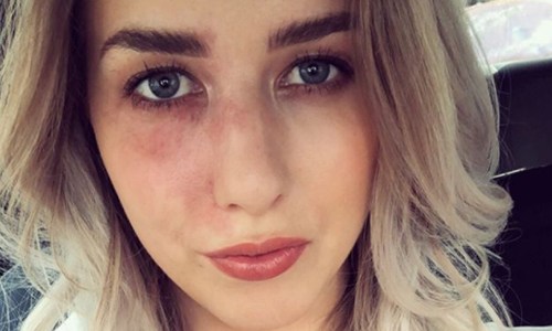 Laura uit ‘Blind Getrouwd’ moet naar ziekenhuis en toont SCHOKKENDE beelden: “Niet voor gevoelige kijkers!” (foto’s)