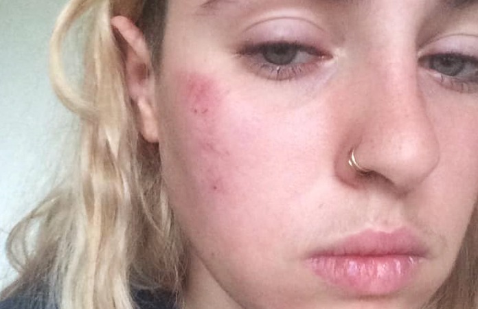 Brusselse vrouw in elkaar geslagen nadat ze vriendin kust: “Ze noemden me een vuile lesbienne”
