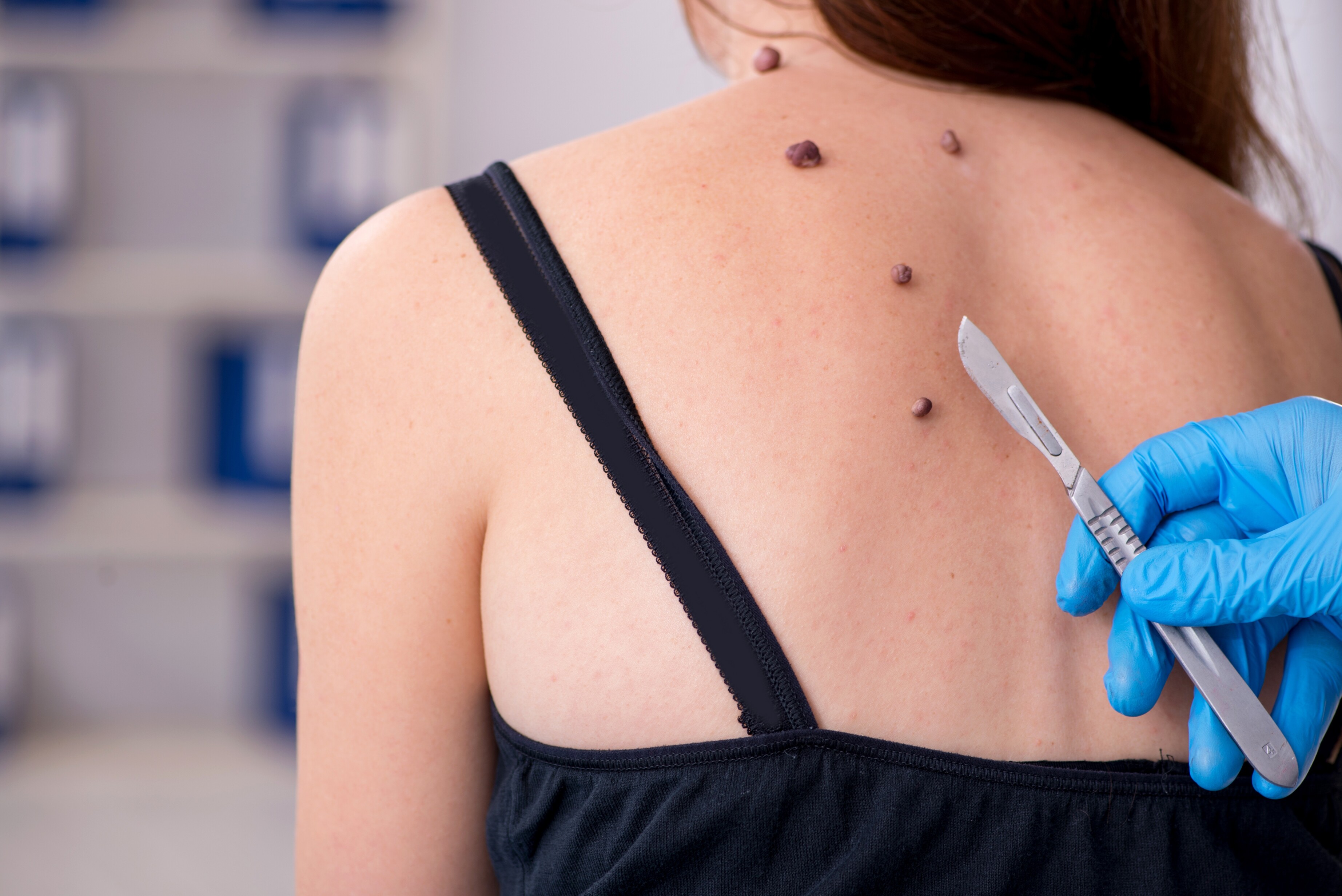 Het ABC van huidkanker