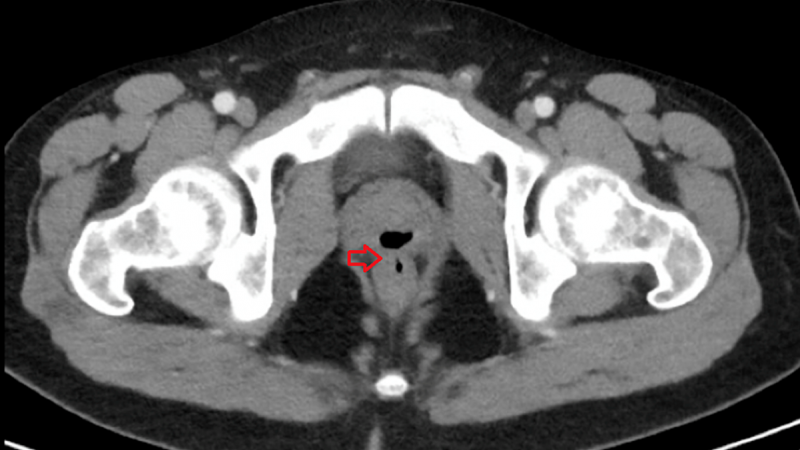 Man heeft gênante aandoening: ejaculeert uit achterwerk en laat winden uit geslachtsdeel
