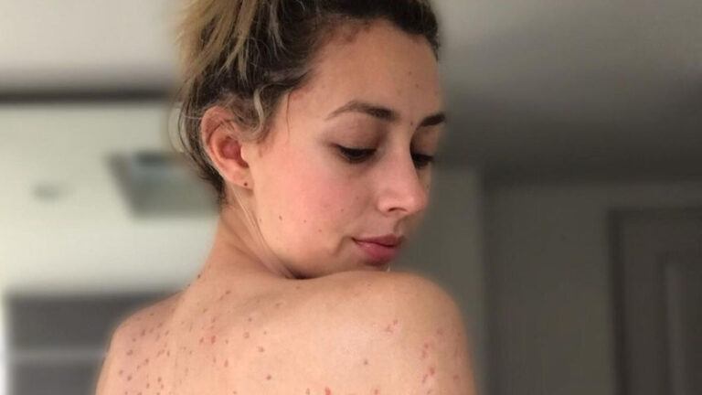 Dame met huidziekte geeft zich (letterlijk) bloot. Fans lovend: “Niets dan schoonheid!” (foto’s)