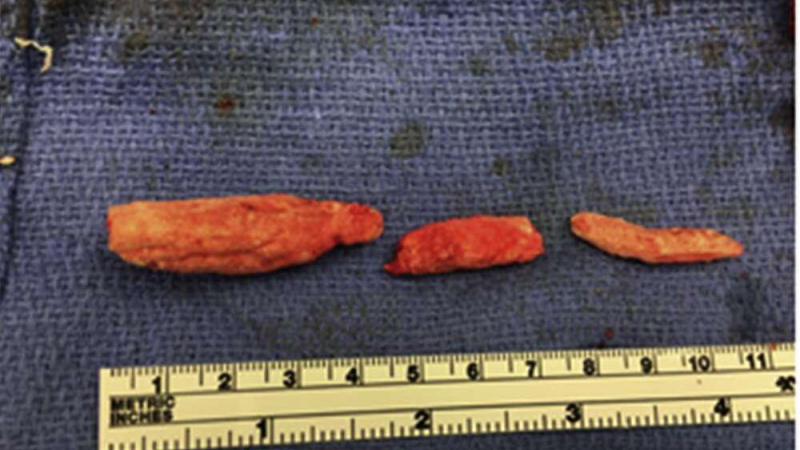 Man spuit DIT in zijn geslachtsdeel om ‘erectiestoornis te genezen’, maar belandt op de spoed