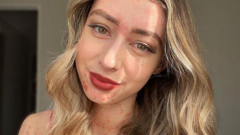 Vrouw toont huidziekte in eerlijke lingeriefoto’s: «Je bent een ware inspiratie»