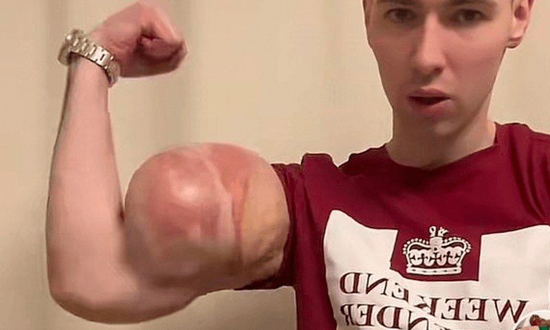 Fans bezorgd om influencer die armen vol olie pompt om er gespierder uit te zien: “Ga NU naar het ziekenhuis!” (video)