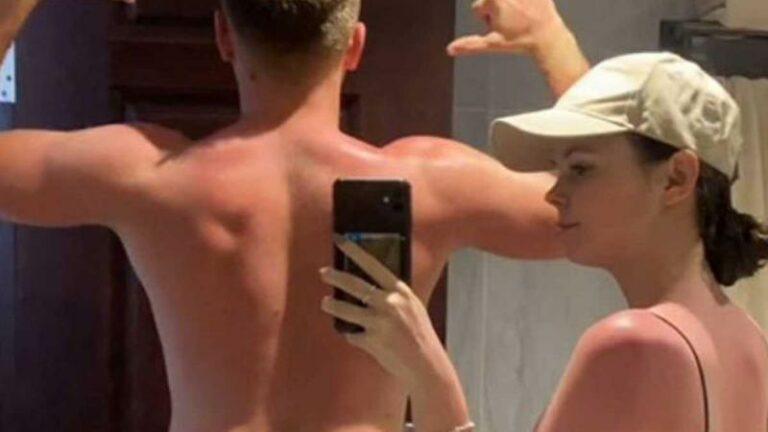 Koppel toont wat ‘valse’ zonnecrème met hun lichaam deed: «Zo erg voor jullie!»