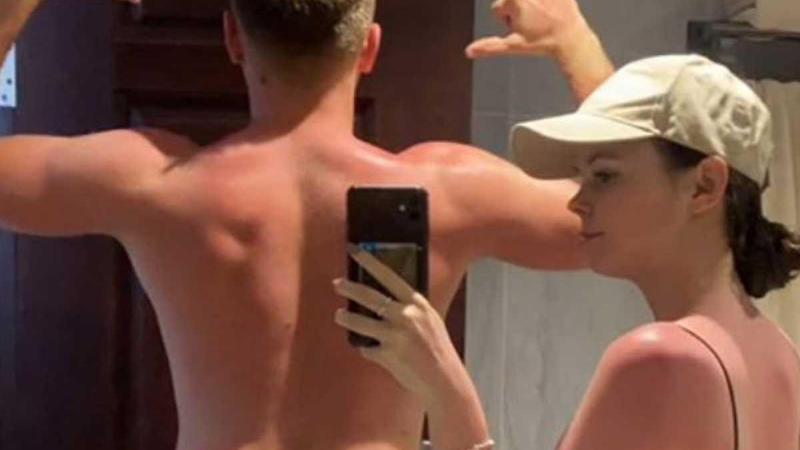 Koppel toont wat ‘valse’ zonnecrème met hun lichaam deed: «Zo erg voor jullie!»