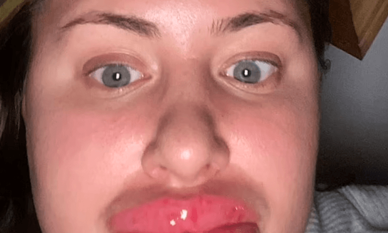Vrouw heeft hevige allergische reactie: “Ze ziet eruit als een personage uit Monsters Inc!” (video)