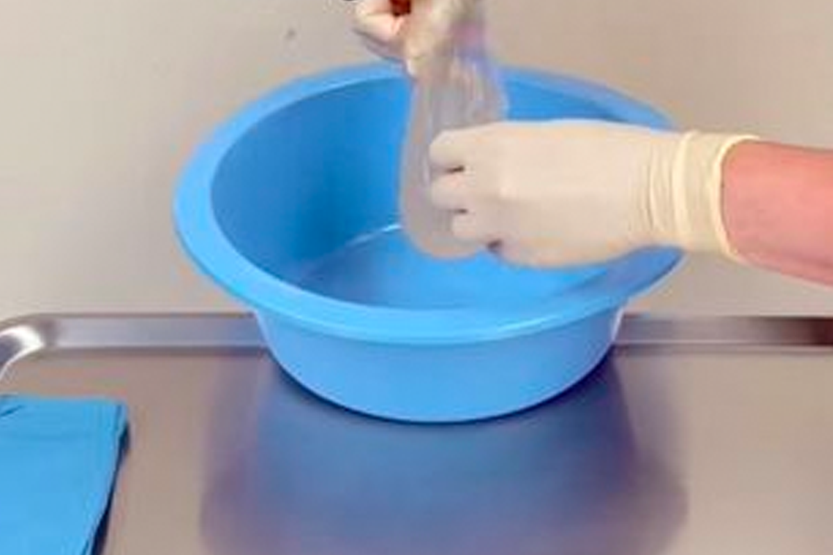 Chirurg op TikTok laat 23 jaar oude borstimplantaten zien in filmpje: “Heel plakkerig!” (video)